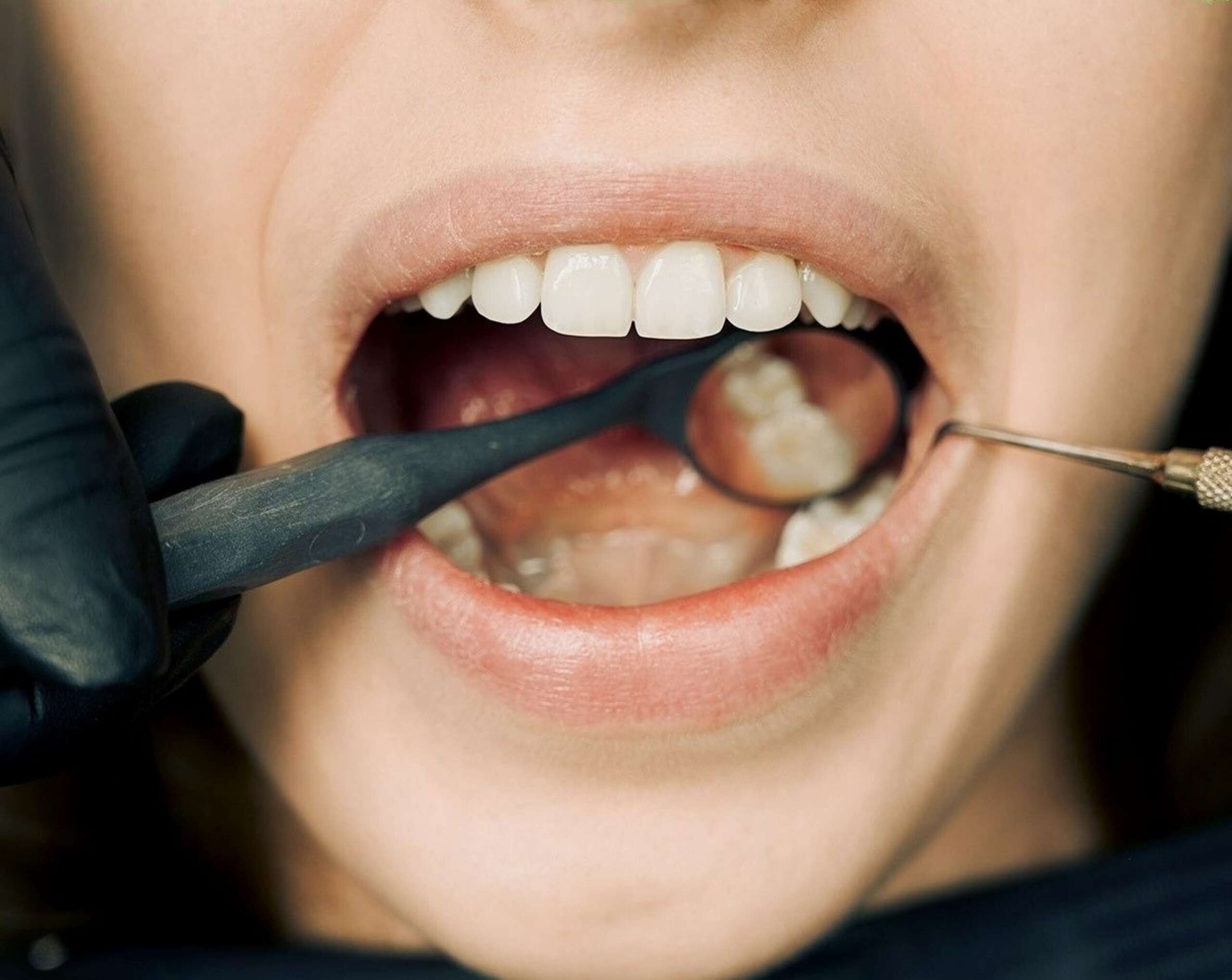 World No Tobacco Day - How Smoking Wrecks Your Oral Health