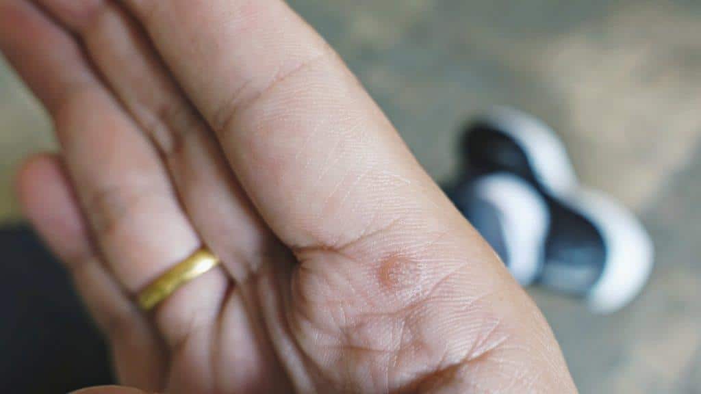 Summertime warts: What they are and how to get rid of them