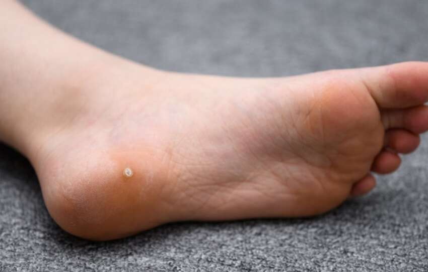 6 ways parents can help prevent summertime warts in children