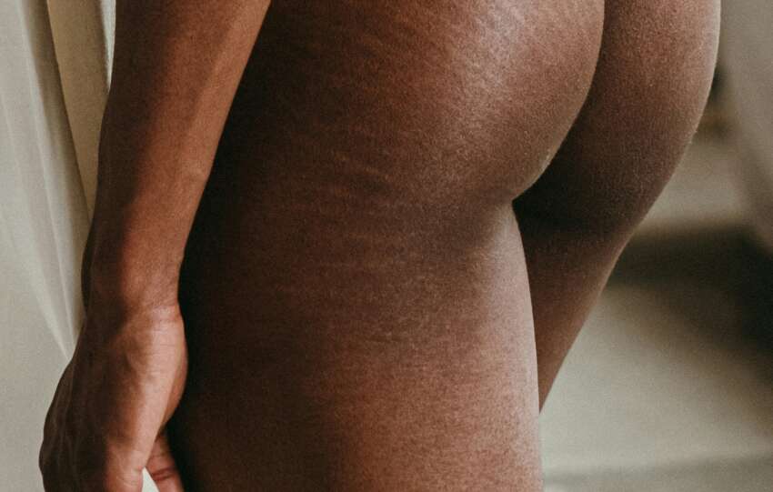 Stretch marks 101: Everything you need to know about the causes, prevention and treatment