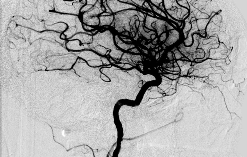 FAQs about strokes: Causes, warning signs and modern neuroimaging