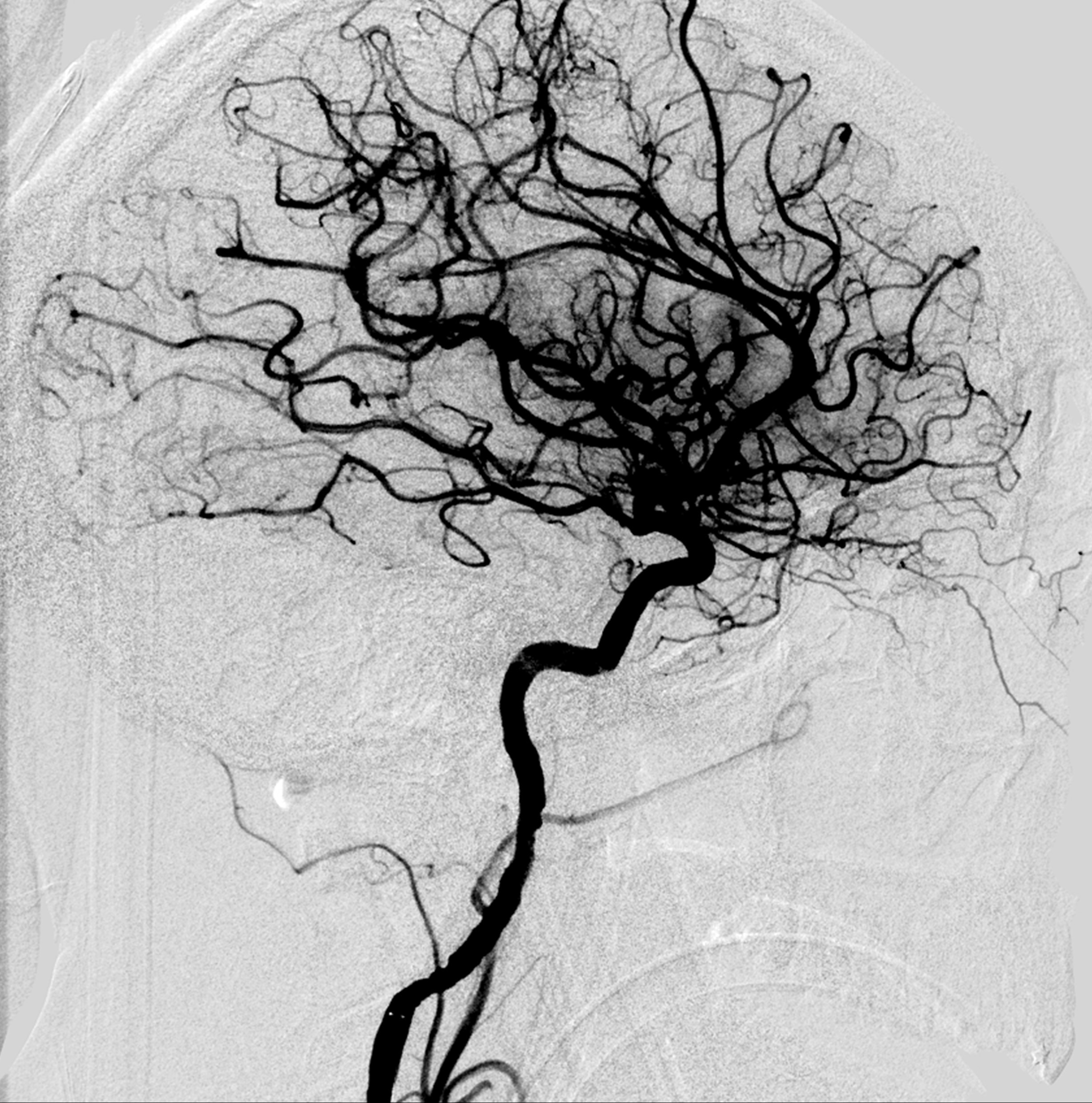 FAQs about strokes: Causes, warning signs and modern neuroimaging