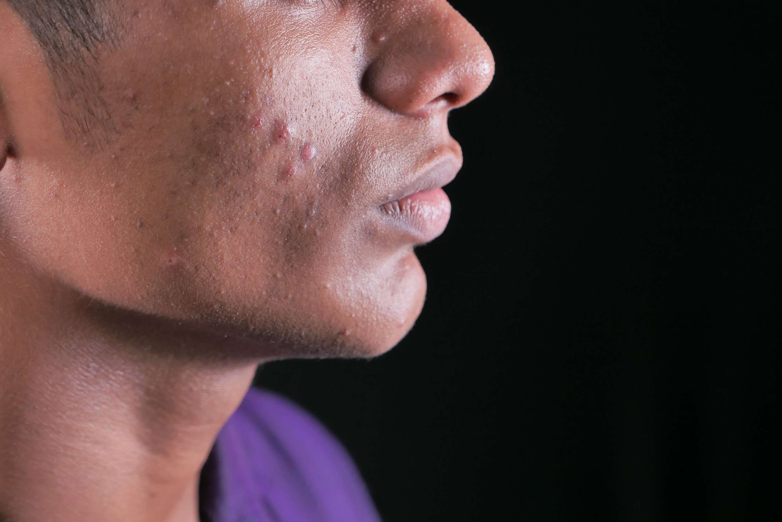 Acne Positivity Day: A Biomedical Scientist debunks some of the most common breakout myths