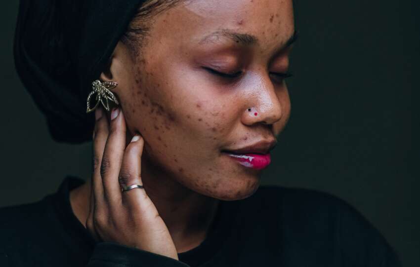 Why your skin starts building dark marks before summer even begins